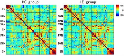 Abnormal developmental trends of functional connectivity in young children with infantile esotropia